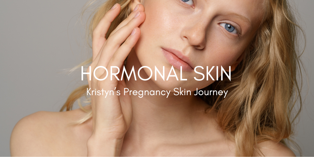 Lady with blonde hair with hand touching cheek. Text overlaid reads: HORMONAL SKIN: Kristyn's pregnancy skin journey