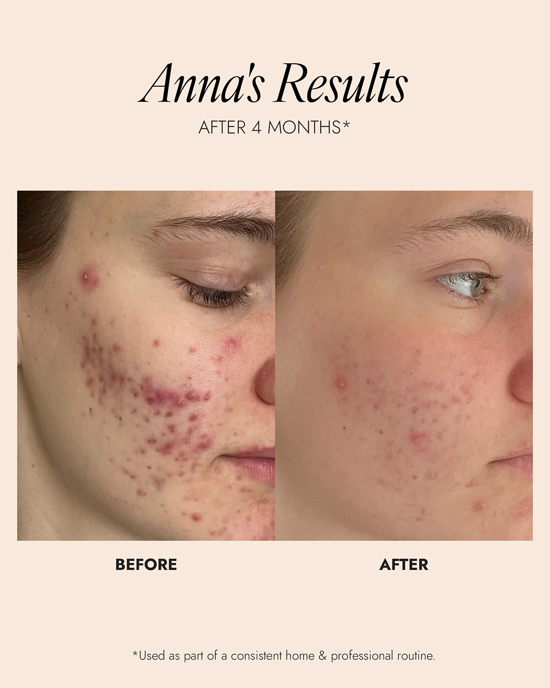Before and after comparison of a person's face with acne, showing results after 4 months.