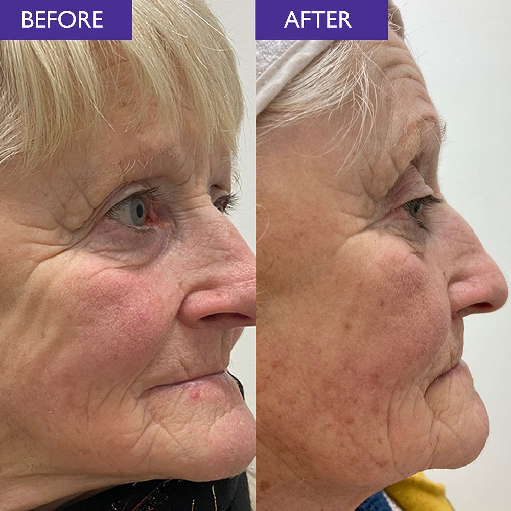 A real customer before and after image of the side of an older woman's face. The before image shows deep wrinkles on her face and the after image shows the depth of these wrinkles reduced. This demonstrates the performance of Skinician Retinol Powerbalm