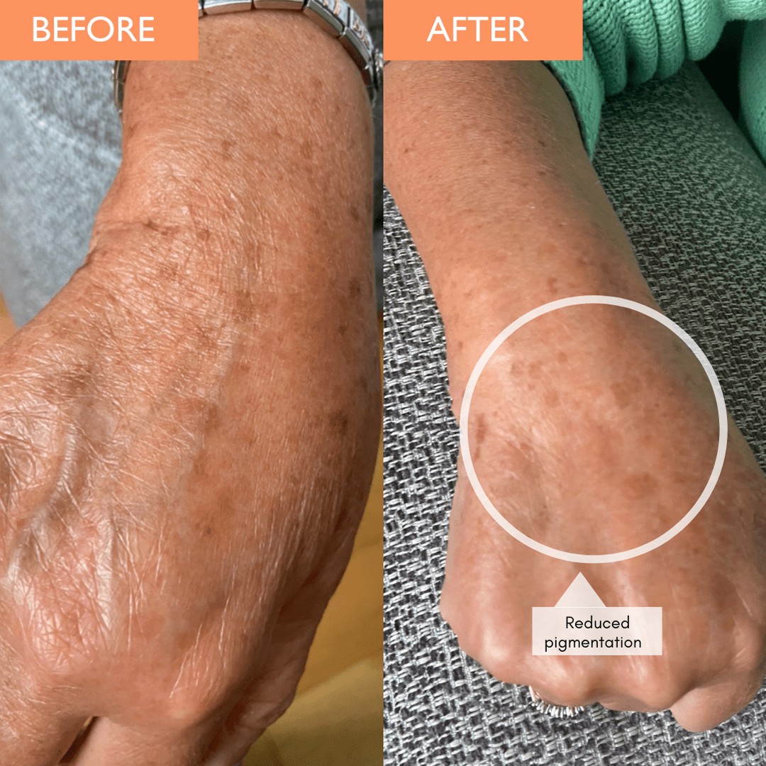Anti-ageing vitamin c serum before and after photos on a womens hand after use. Reduced pigmentation is shown in the form of reduced colouring from brown age spots.