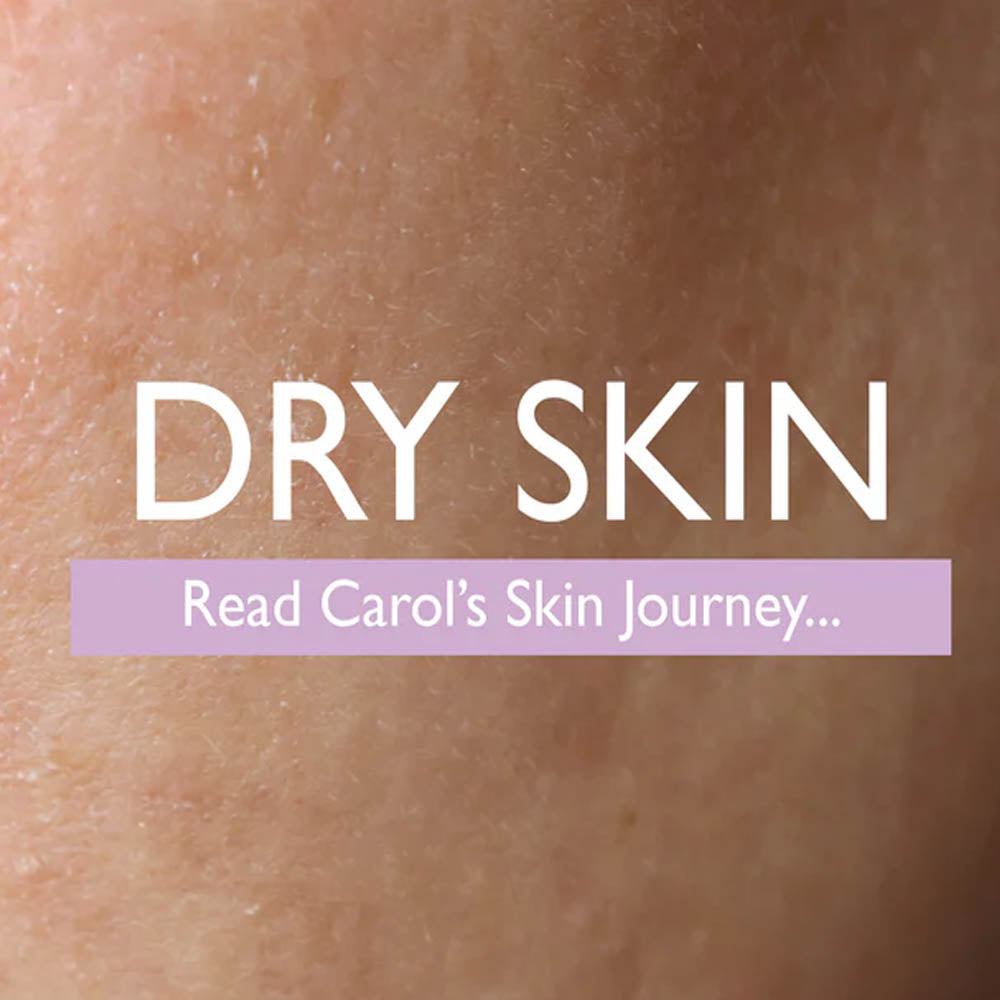 Close-up of dry skin texture with text overlay: ‘Dry Skin – Read Carol’s Skin Journey...’ on a lavender background.