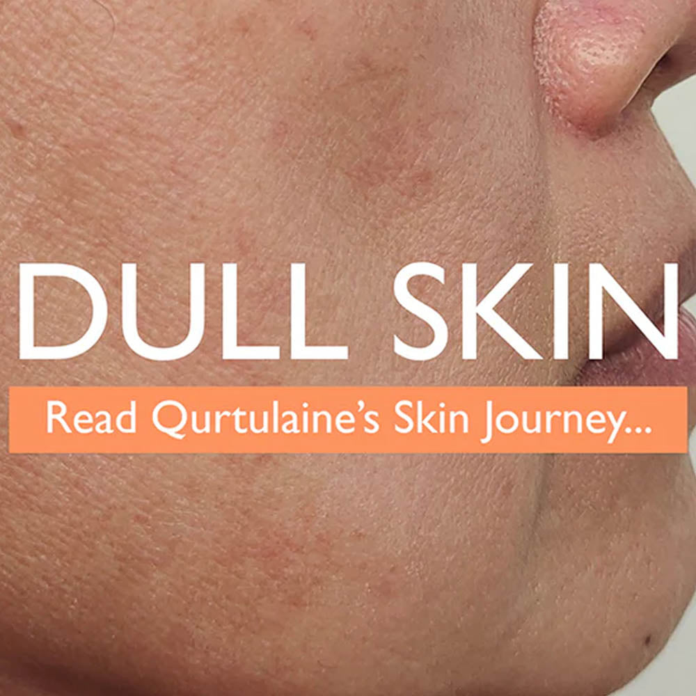 Close-up of a woman’s lower face with visible skin texture and hyperpigmentation. Text overlay reads: ‘Dull Skin – Read Qurtulaine’s Skin Journey...