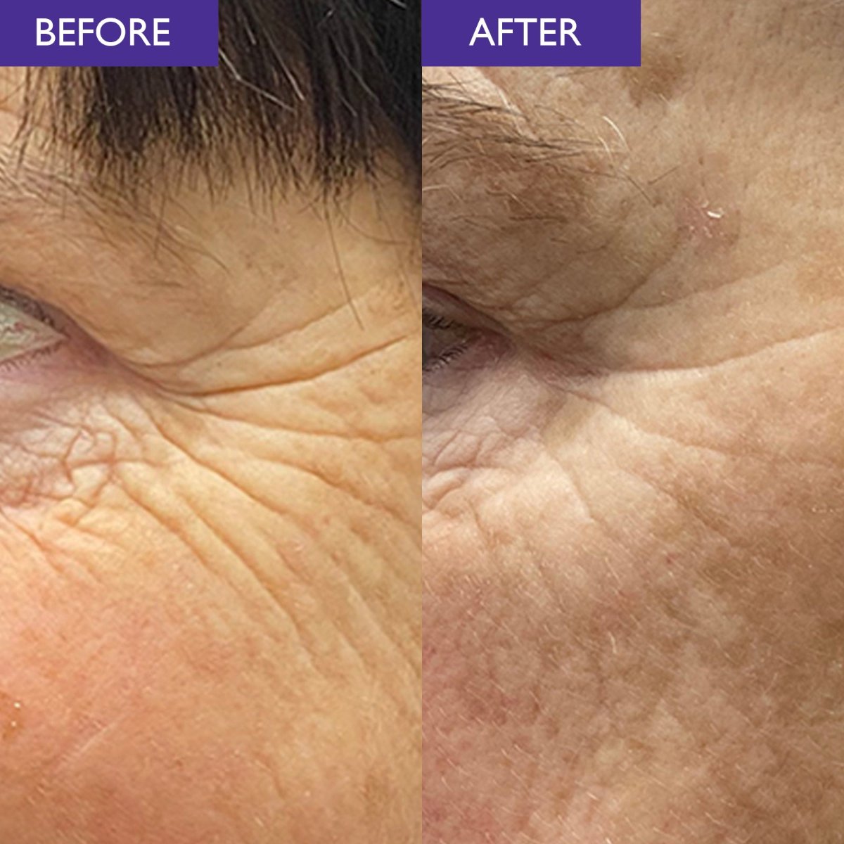 A real customer before and after close up image of a woman's crows feet. The before image shows deep wrinkles and the after image shows the depth of these wrinkles reduced. This demonstrates the performance of Skinician Retinol Powerbalm