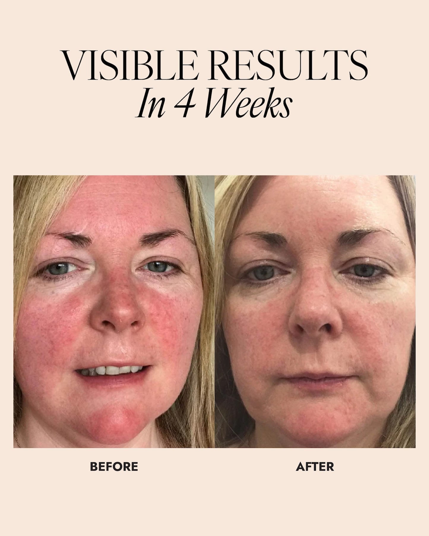 Before and after comparison of a woman's face with visible improvement in skin redness.