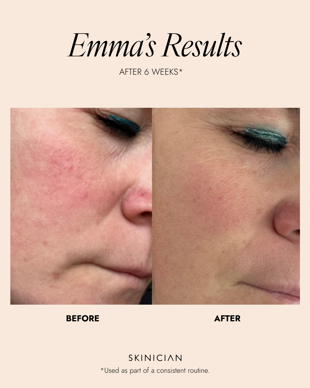 Before and after skin treatment results for 'Emma's Results' after 6 weeks on a beige background, showing calm, soothed and nourished skin.