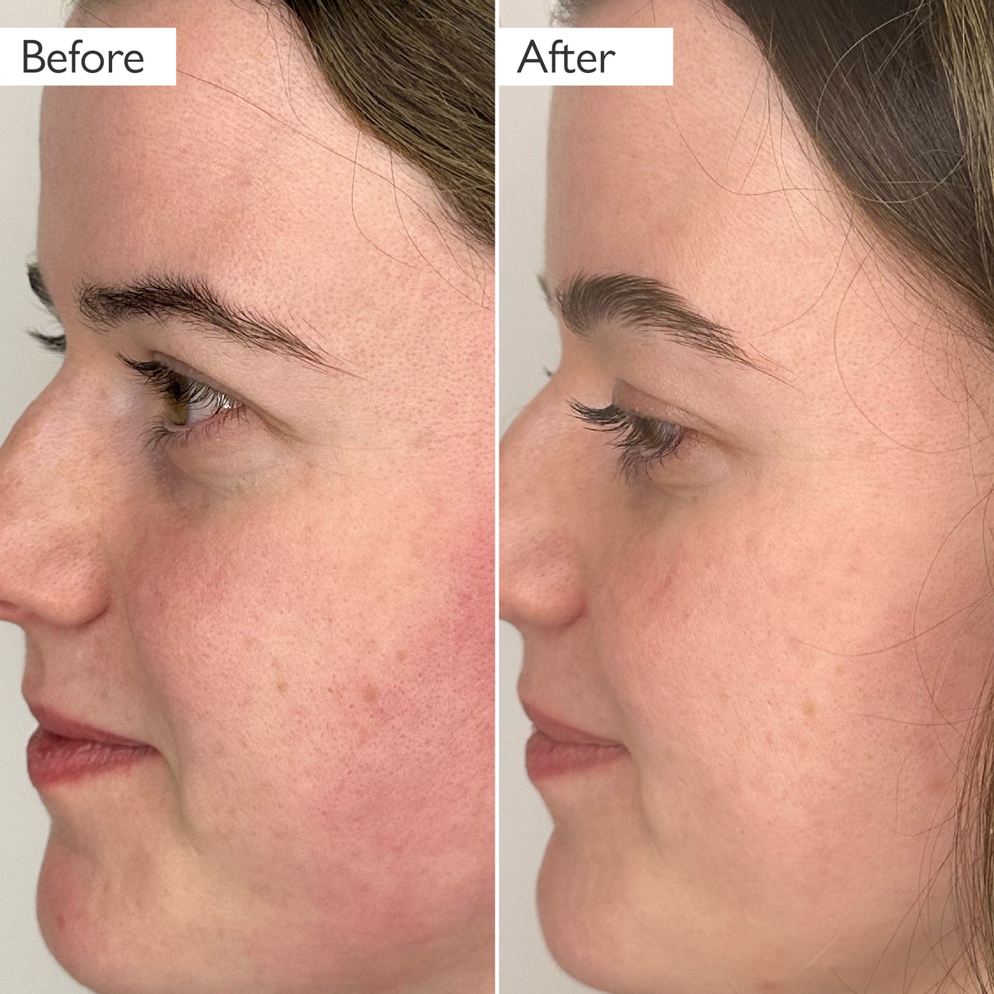 before and after image showing a reduction in skin redness and blotchiness