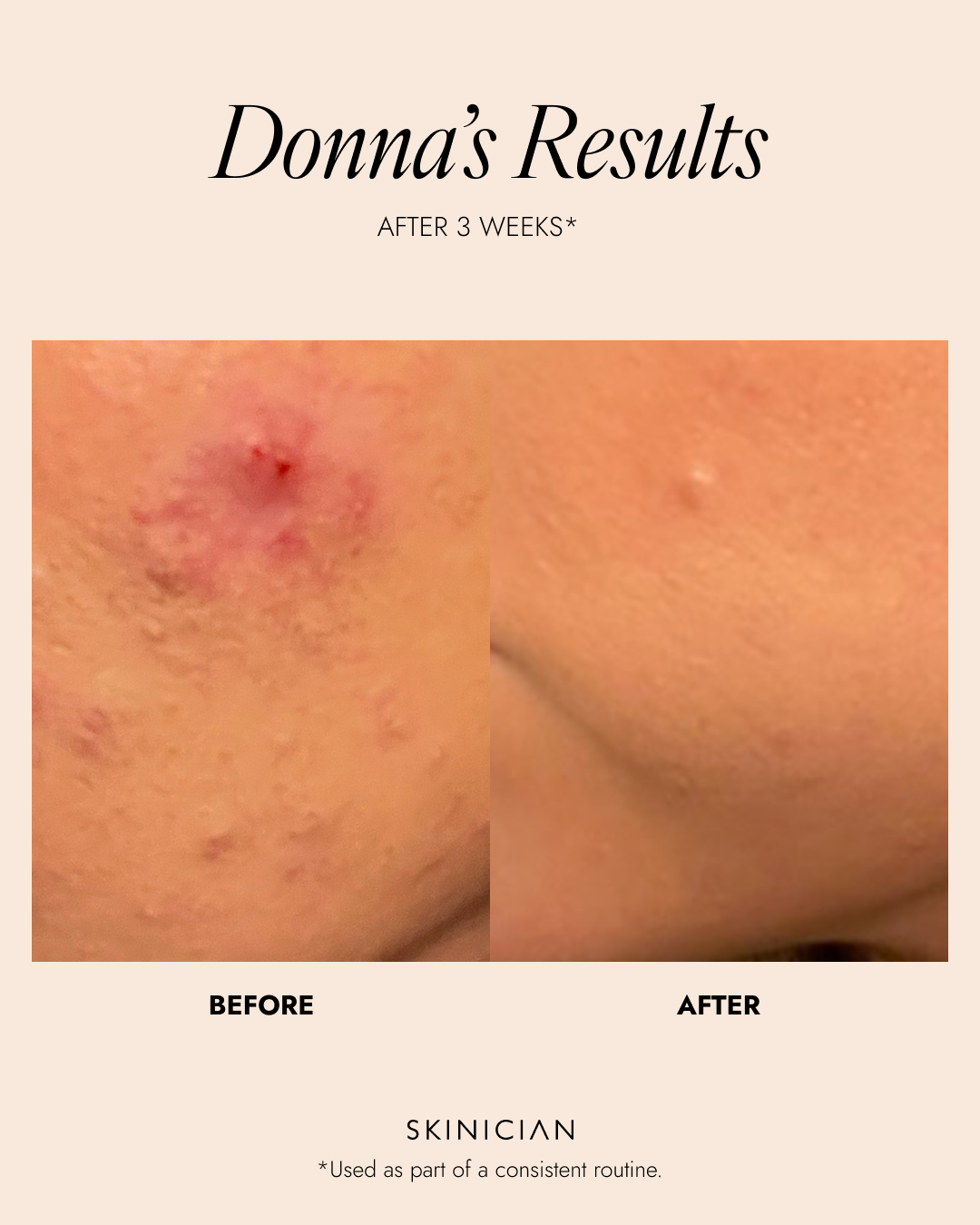 Before and after comparison of a woman's face with text indicating 'Donna's Results' after 3 weeks showing improved skin texture and skin clarity.