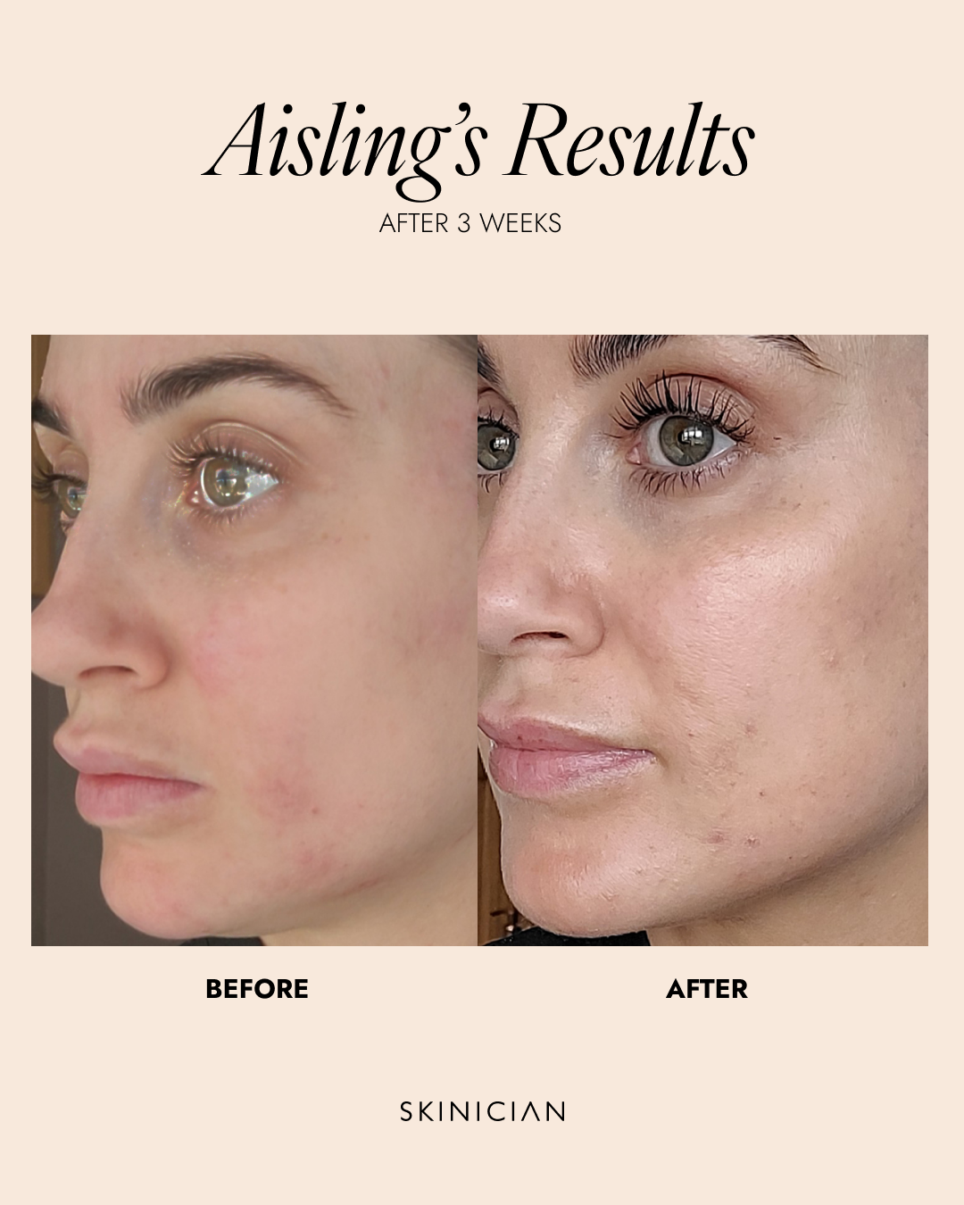 Before and after comparison of a woman's face with text indicating 'Aisling's Results' after 3 weeks.