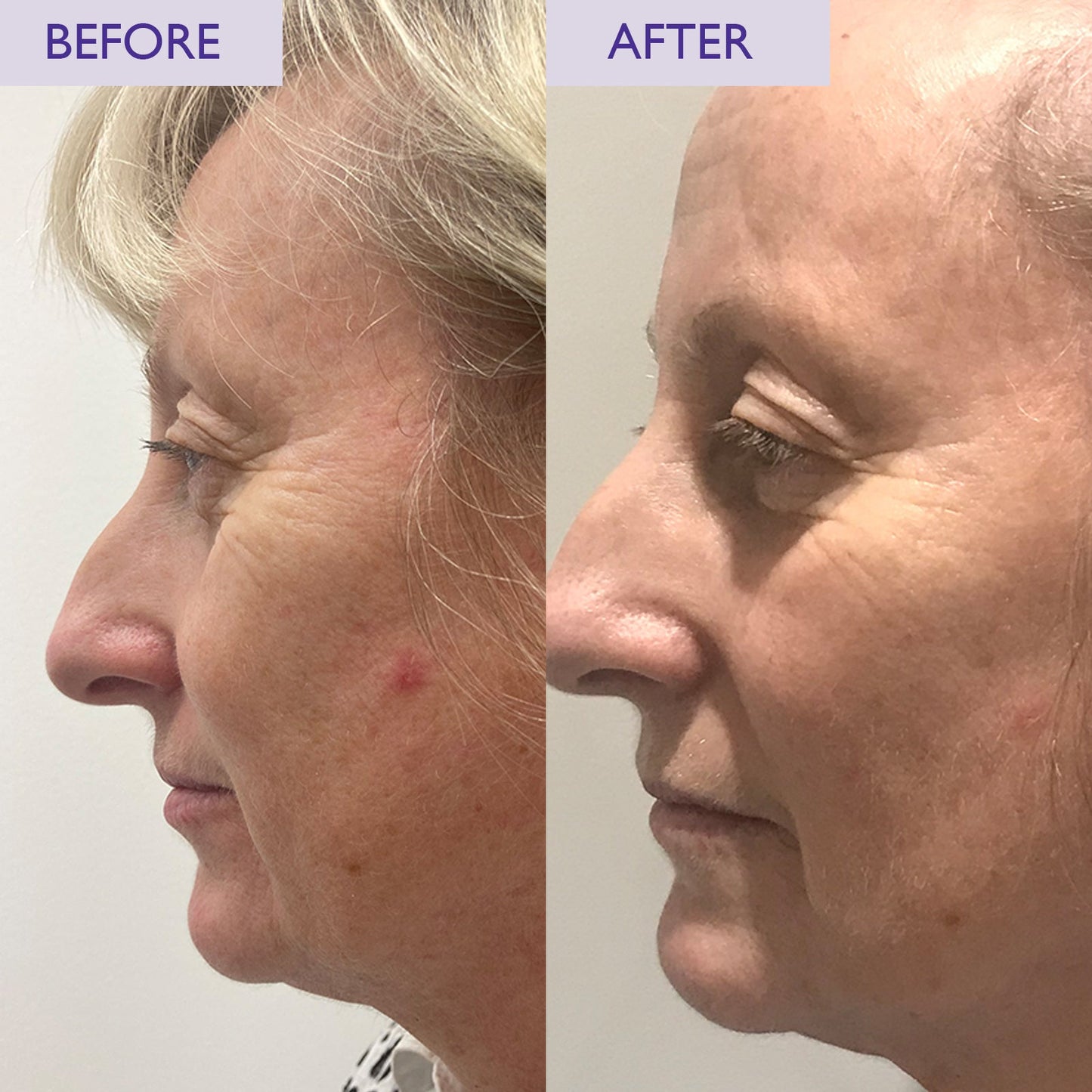 Before and after image of a lady having used retinol night cream over 4 weeks. Improvement in wrinkles and breakouts can be seen