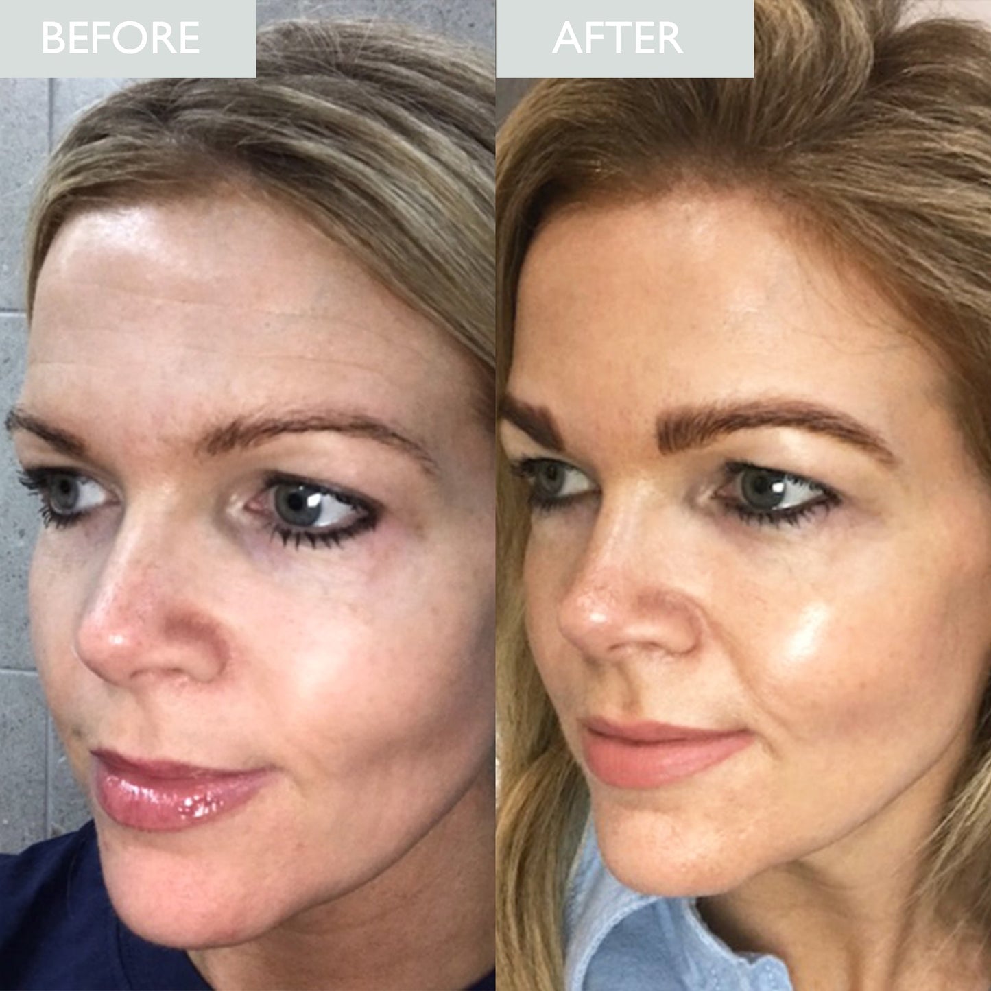 Before and after photo of a lady having dry skin, after using Skinician restoring night cream.