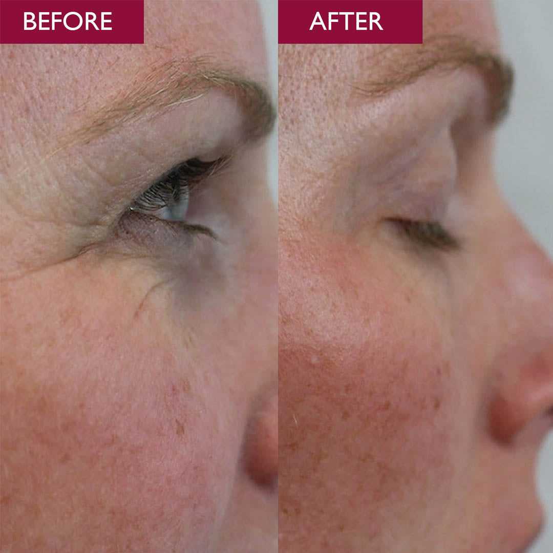 Before and after of a womens eyes from the side after using advanced eye repair cream. Shows less wrinkles and brighter skin under eyes