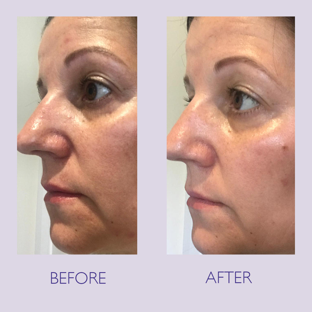 Before and after of a lady using Skinician products for pigmentation and signs of ageing.