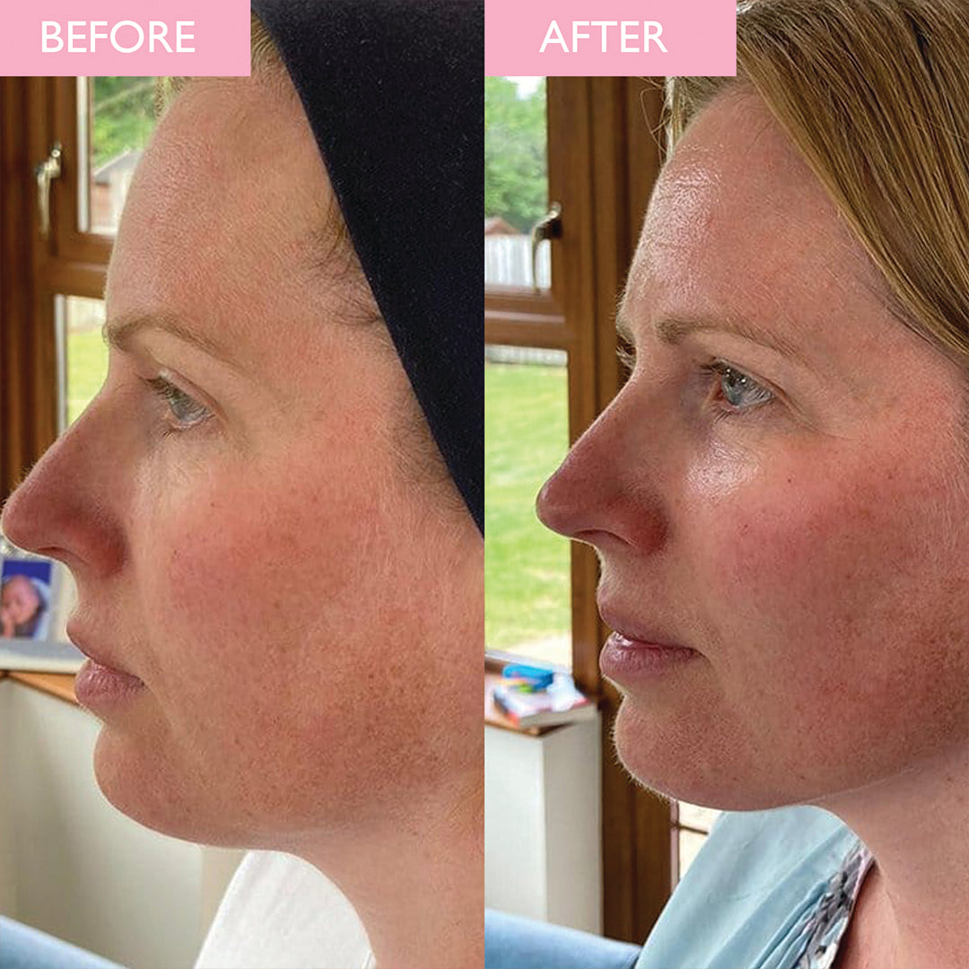 SKINICIAN Skin Exfoliator before and after on a women showing a brighter complexion