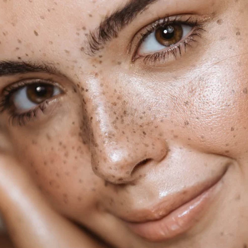 Close-up of a smiling woman with radiant skin and visible freckles, showcasing a healthy, natural complexion.