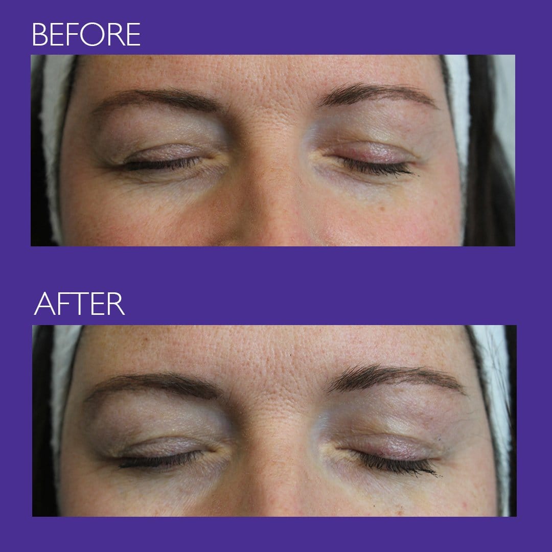 A lady showing results before and after using the peptide eye cream .