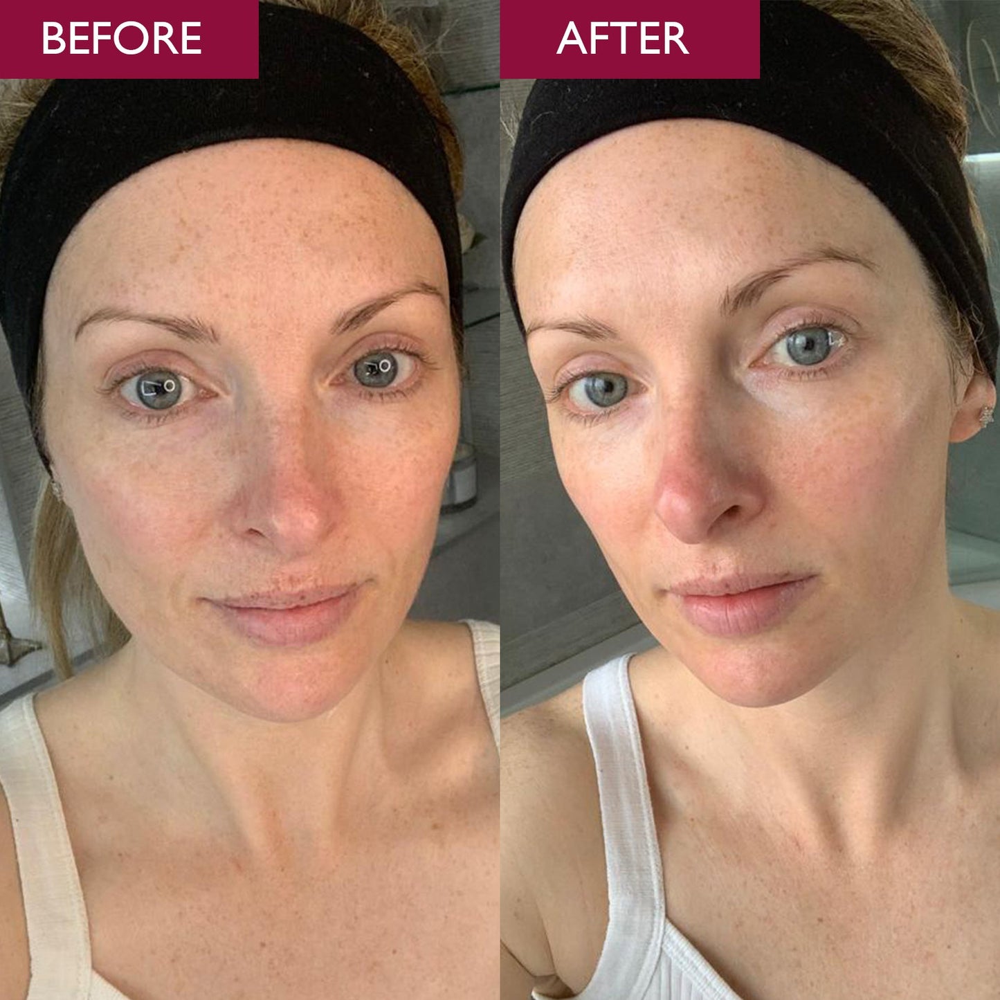 Before and after image of a lady having used the brightening enzyme peel mask from Skinician.