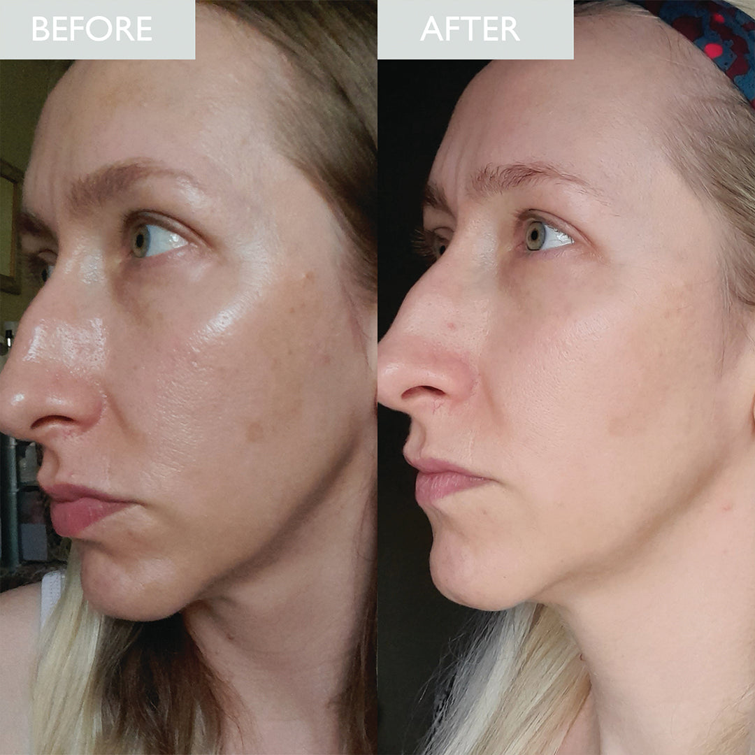 Moisturizer with spf 30 before and after image of a lady who has oily skin before using the product and an improvement of less oil shown on her skin after using the SPF moisturizer