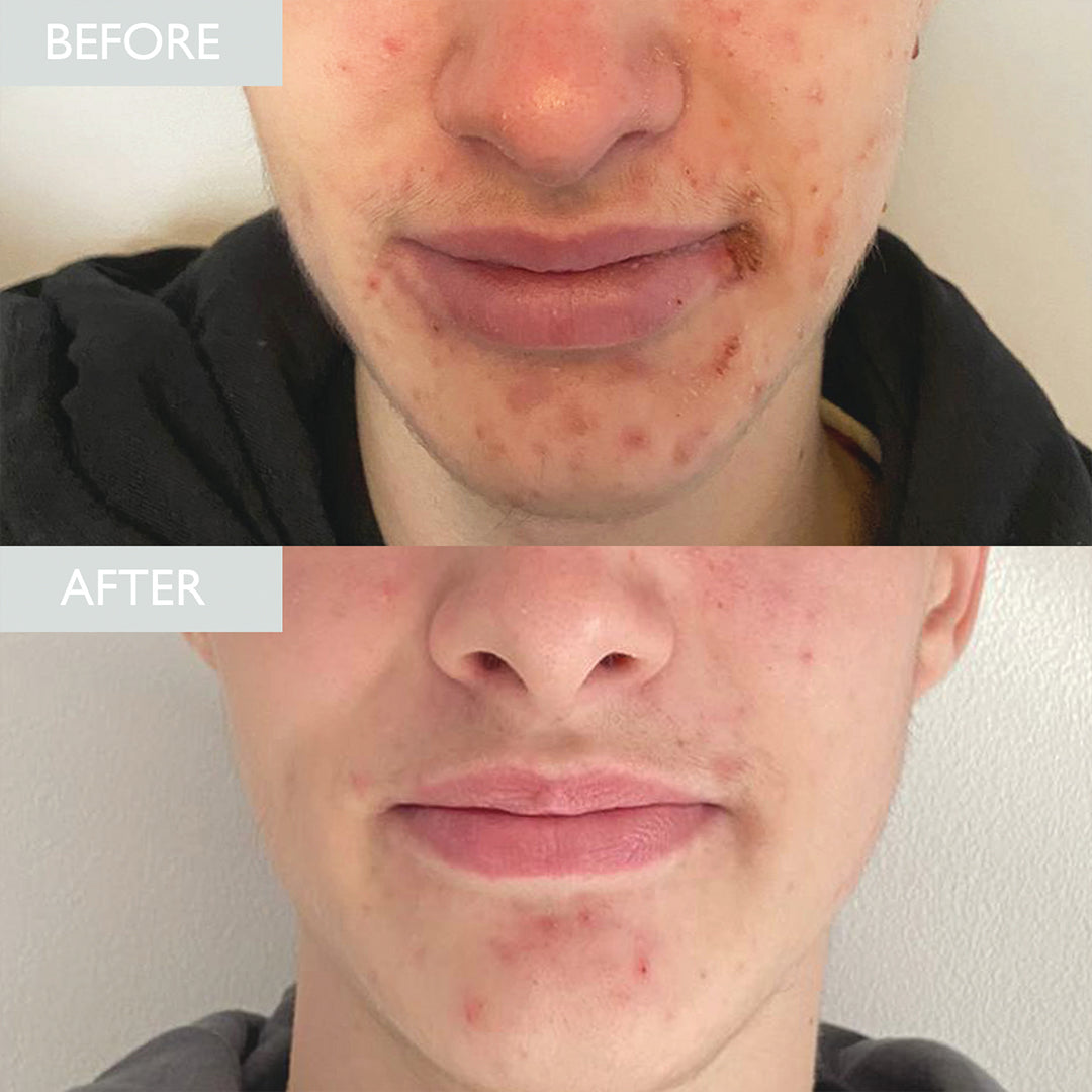 Before and after image of a male who used revitalising cleanser to calm and reduce inflammation on his acne breakouts.