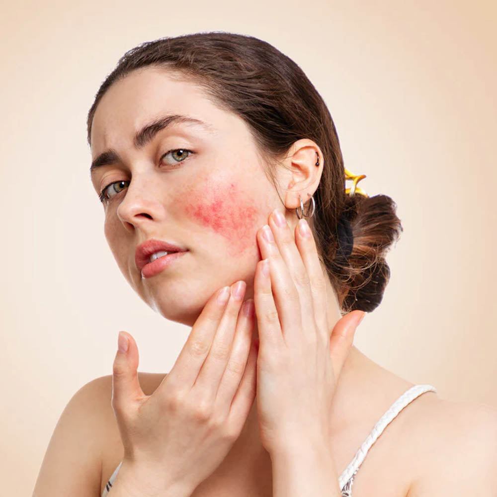Image of a woman with severe rosacea i.e. red cheeks, touching her hands to her face in a concerned way