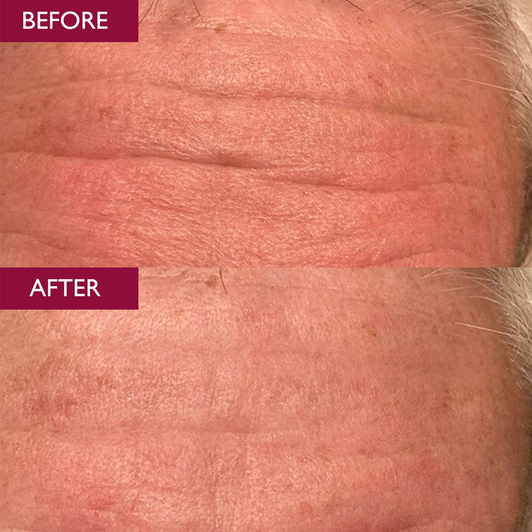 A before and after picture of a mans forehead, showing results from using our firming serum.  Reduced fine lines and wrinkles are seen.