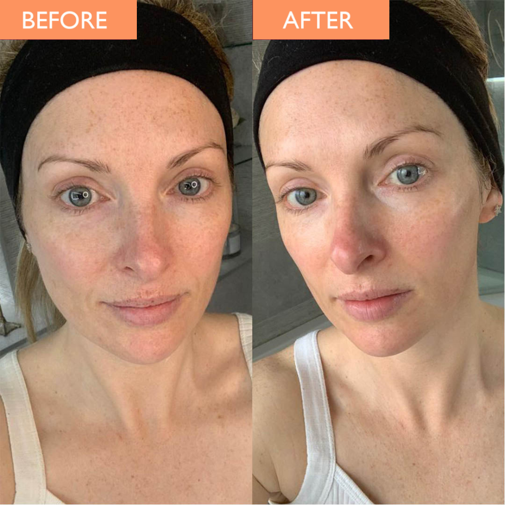 Enzyme before and after shows the same woman with glowing skin after using the professional enzyme mask.