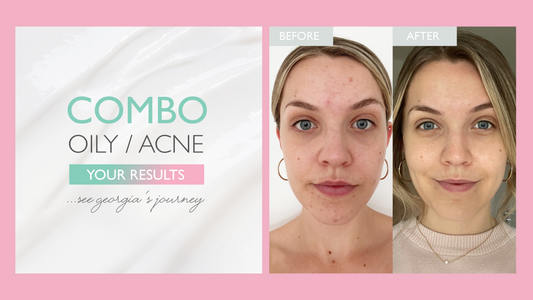 Georgia's Skin Journey: Combination Skin (Acne/ Oily skin)