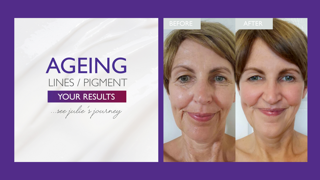 Julie's Skin Journey: Treating Fine Lines, Wrinkles & Pigmentation with SKINICIAN