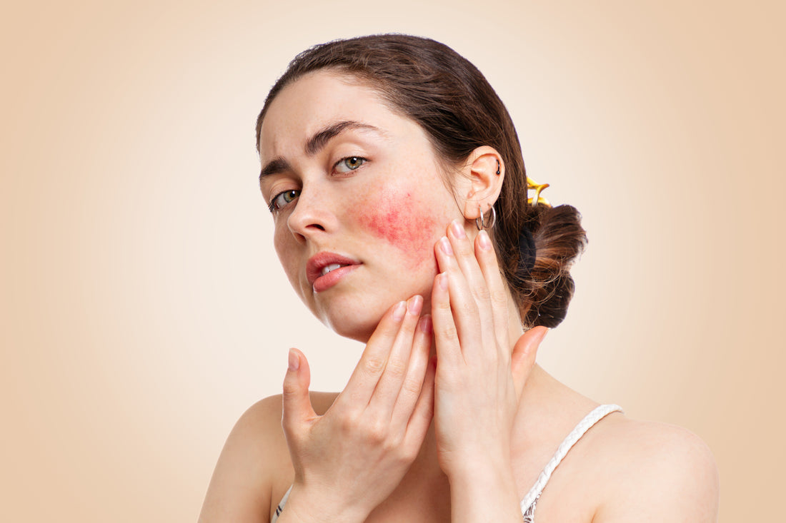 Rosacea and Hyaluronic Acid: Everything You Need to Know