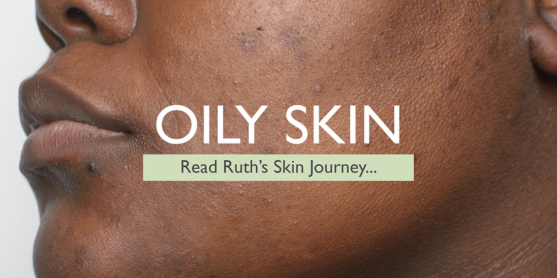 Ruth’s Oily Skin Journey to Happy, Healthy Skin