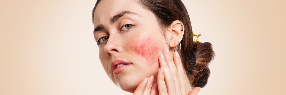 Image of a woman with skin redness, pressing her hands against her cheek, where the inflammation is visible.