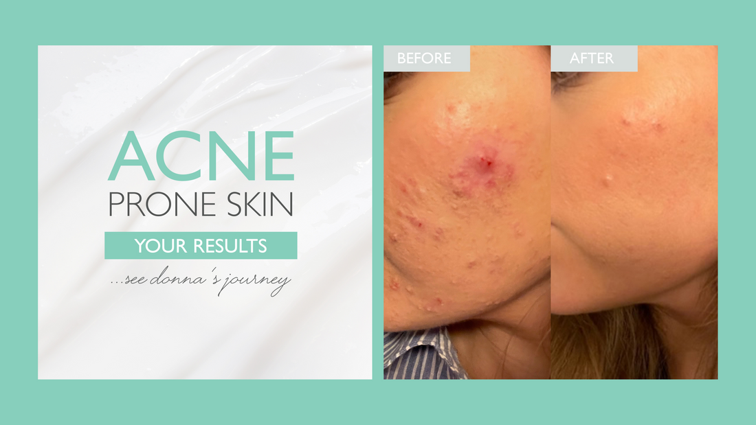 Donna's Skin Journey: How To Treat Acne with SKINICIAN