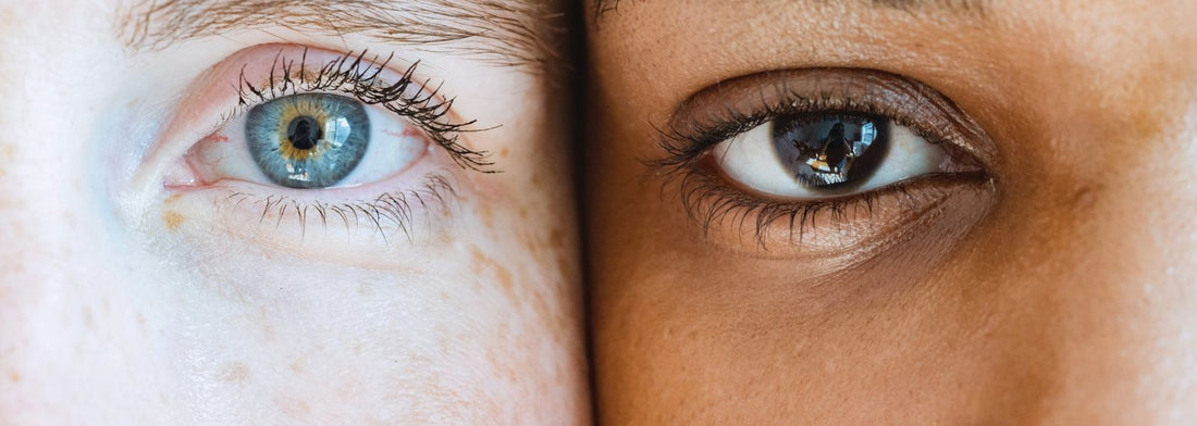 Causes of Hyperpigmentation Under the Eyes
