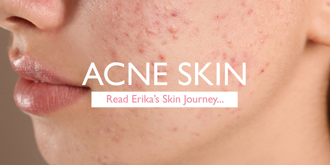 Erika’s Acne Journey to Happy, Healthy Skin