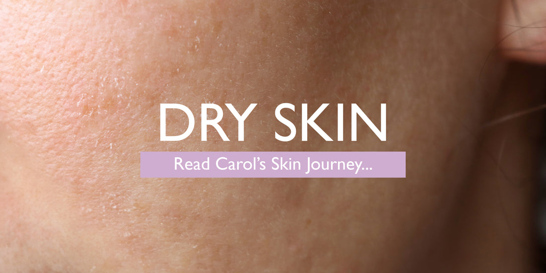Carol’s Dry Skin Journey to Happy, Healthy Skin