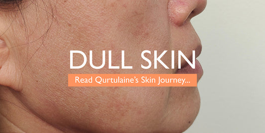 Qurtulaine’s Dull Skin Journey to Happy, Healthy Skin