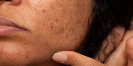 How to treat pigmentation: the causes, the prevention and the treatments