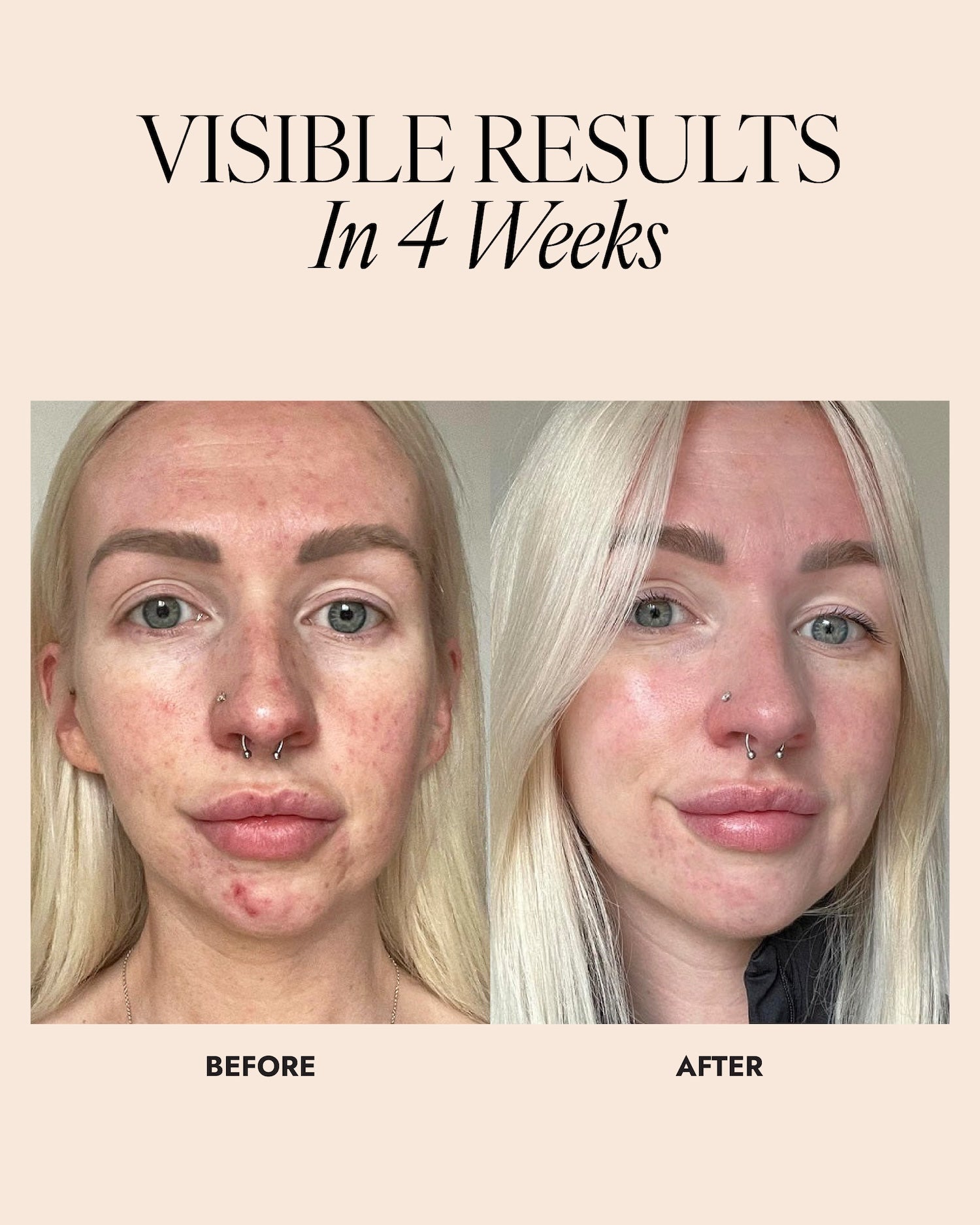 Before and after image of a women, showing improvement in breakouts after using skinician products for 4 weeks.