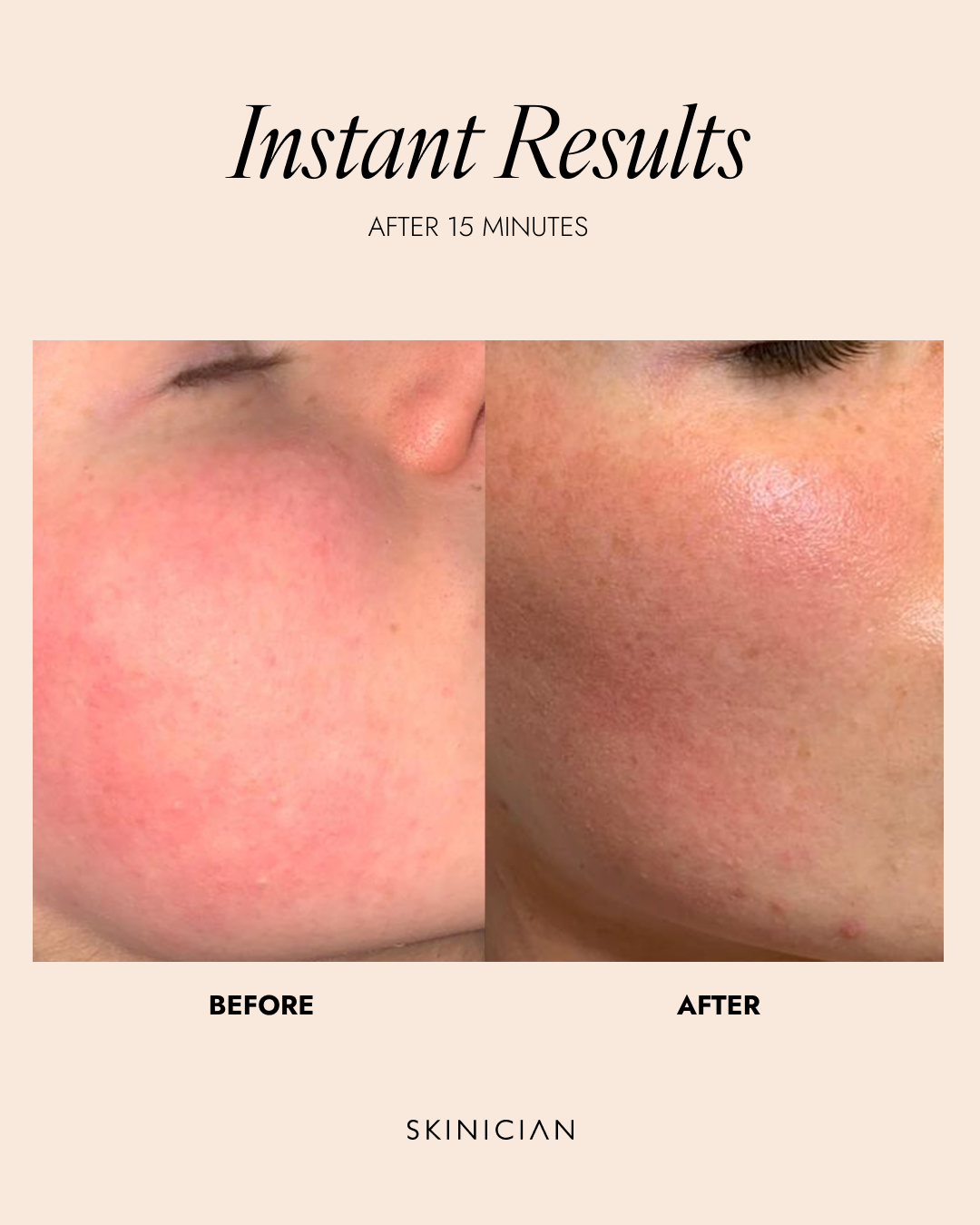 Before and after comparison of skin treatment with 'Instant Results' text and 'Skinician' branding.