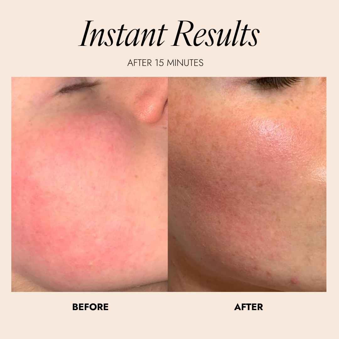 Before and after comparison of skin treatment with 'Instant Results' text and 'Skinician' branding.
