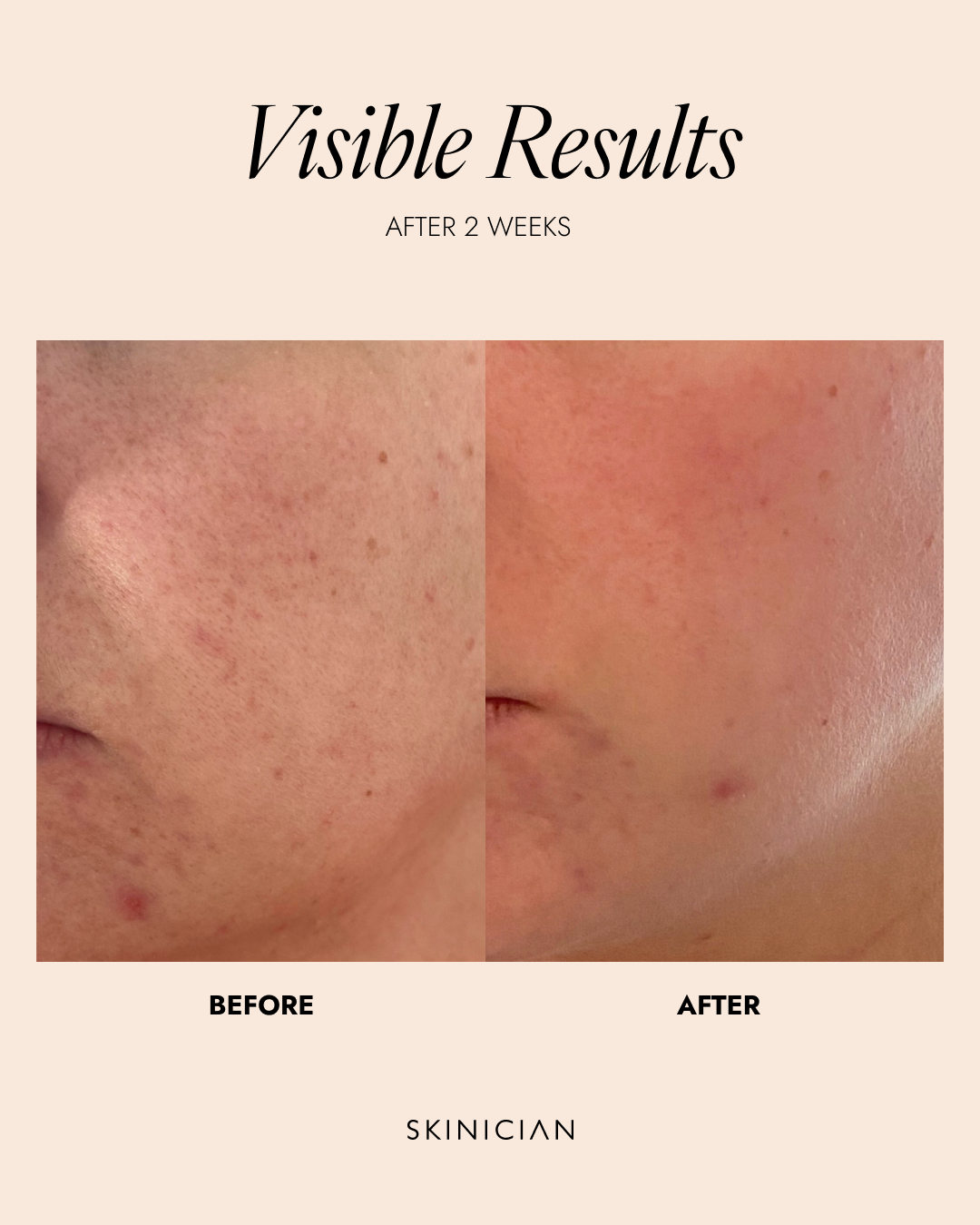 Before and after skin treatment comparison by Skinician, showing visible results after 2 weeks.