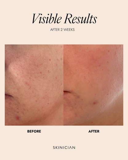 Before and after skin treatment comparison by Skinician, showing visible results after 2 weeks.
