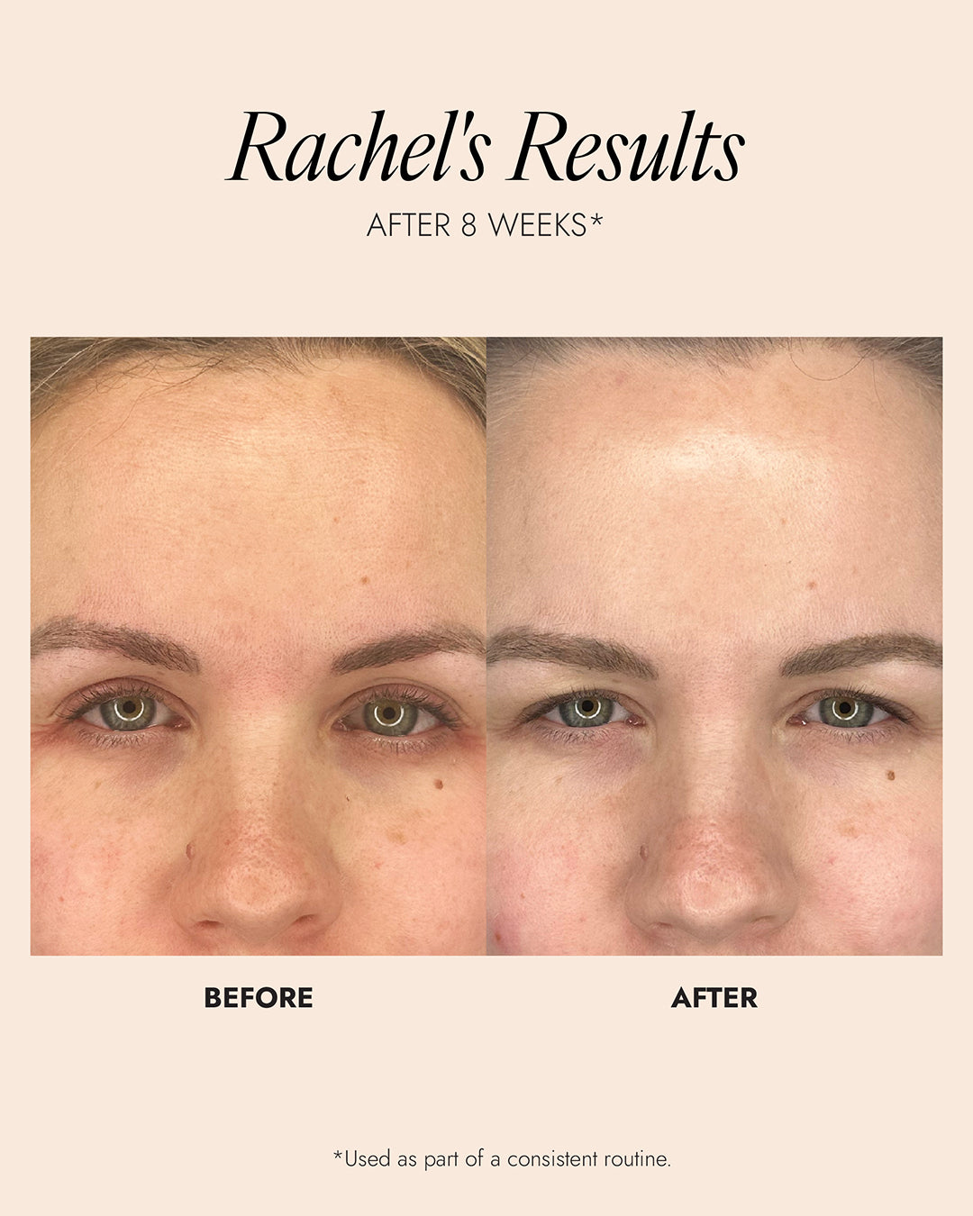 Before and after comparison of facial skin treatment on a beige background with 'Rachel's Results' text.