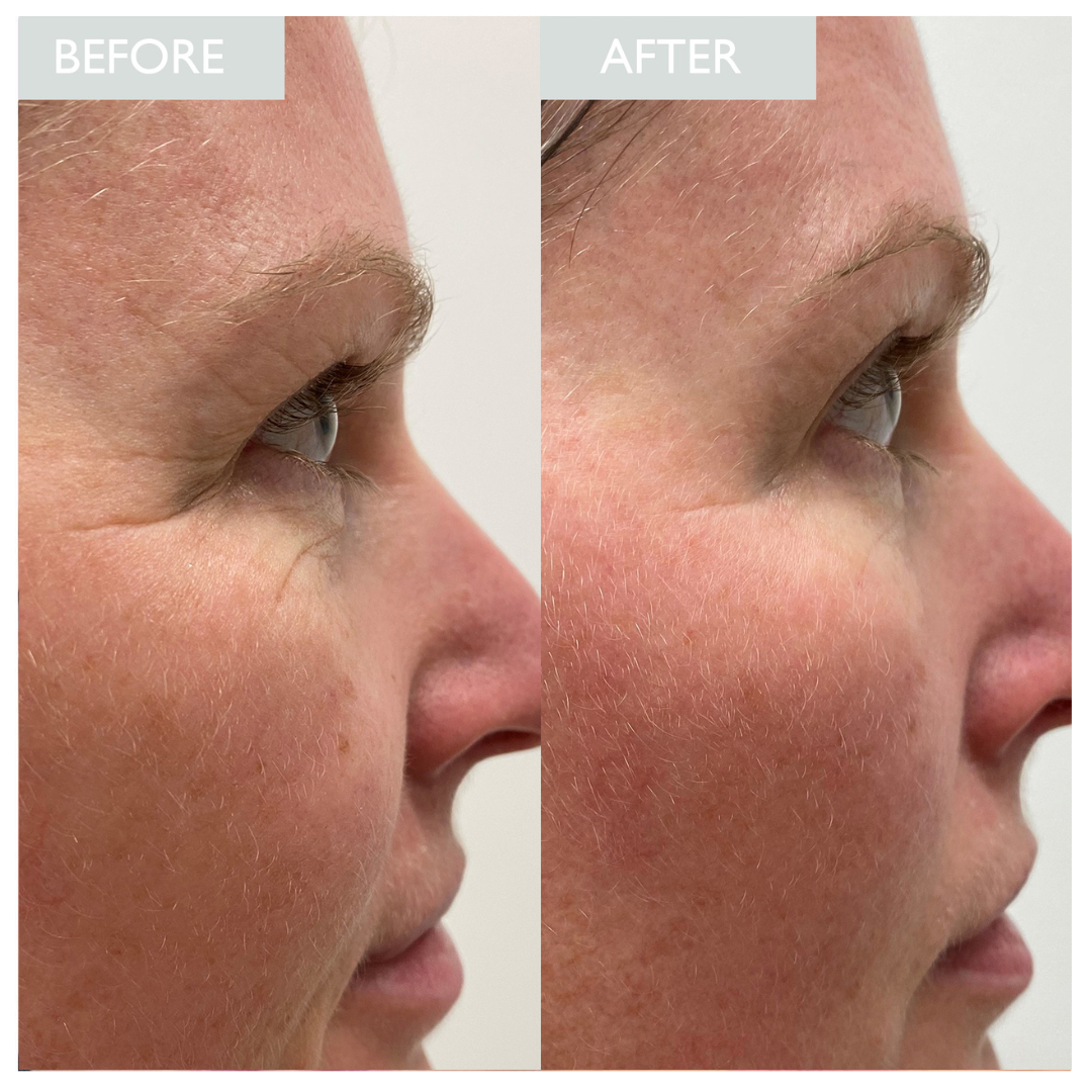 Hyaluronic Spheres for Skin SKINICIAN