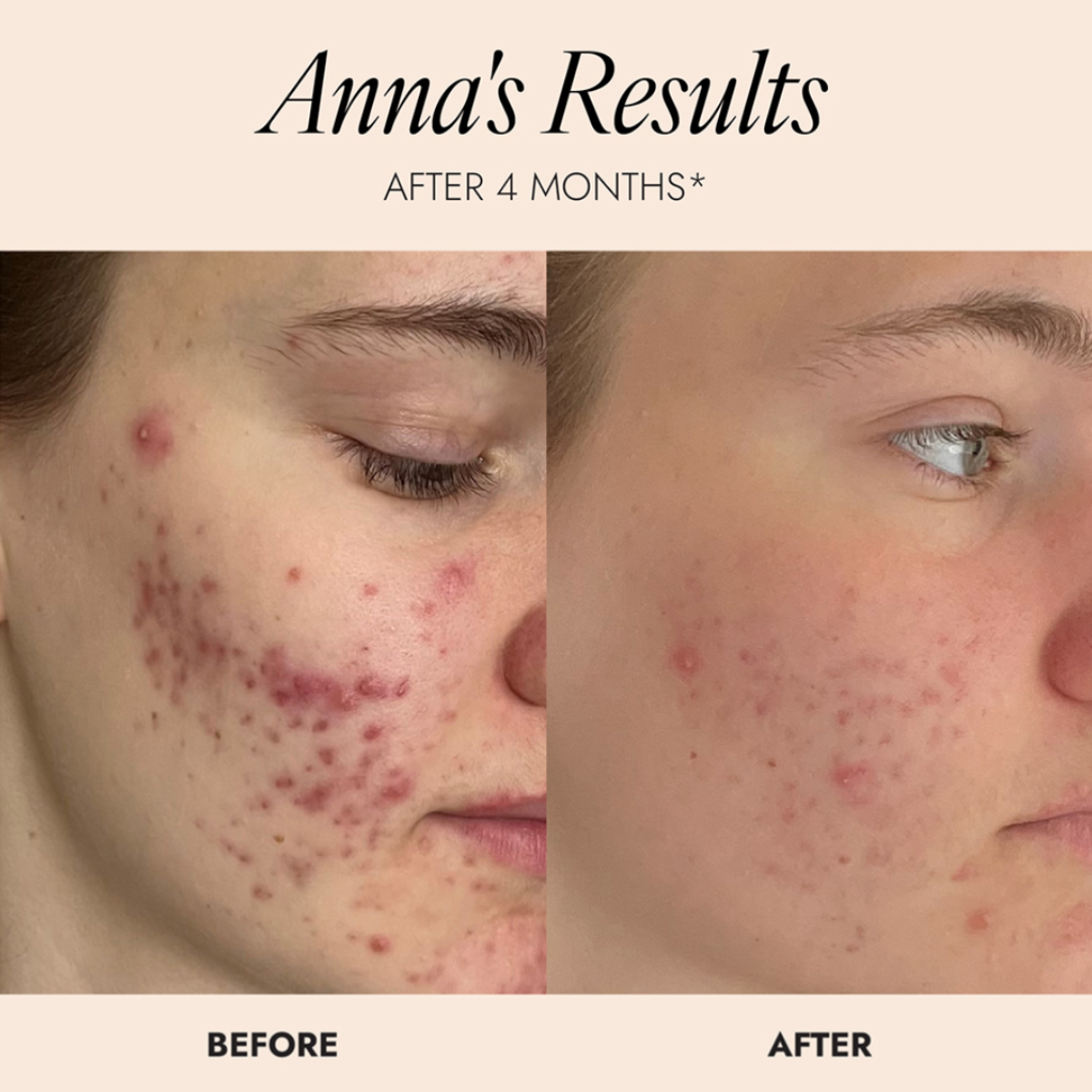 Before-and-after skin comparison of a woman's face showing improvement in breakouts and inflammation after 4 months, with the text 'Anna's Results AFTER 4 MONTHS*' at the top and 'BEFORE' and 'AFTER' labels at the bottom.