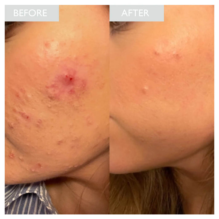 Zinc PCA Skin Care Zinc PCA Benefits for Skin SKINICIAN