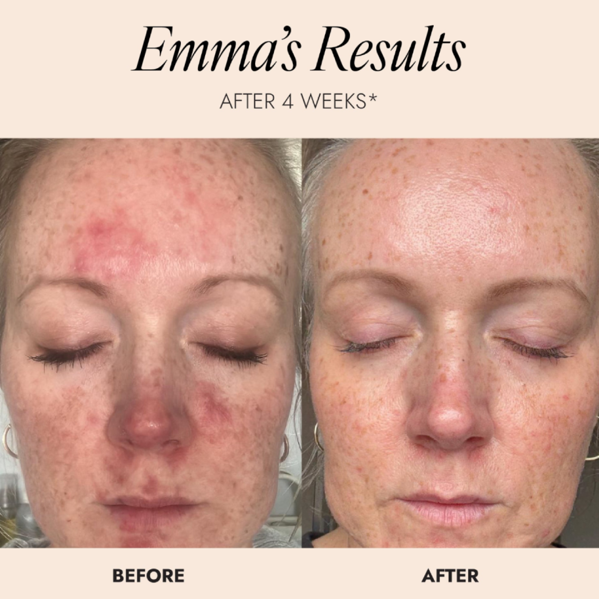 Before-and-after facial skin comparison labeled 'Emma's Results' with 'AFTER 4 WEEKS'. The left side shows red, bumpy, breakout-prone skin, and the right side shows clearer, smoother skin.