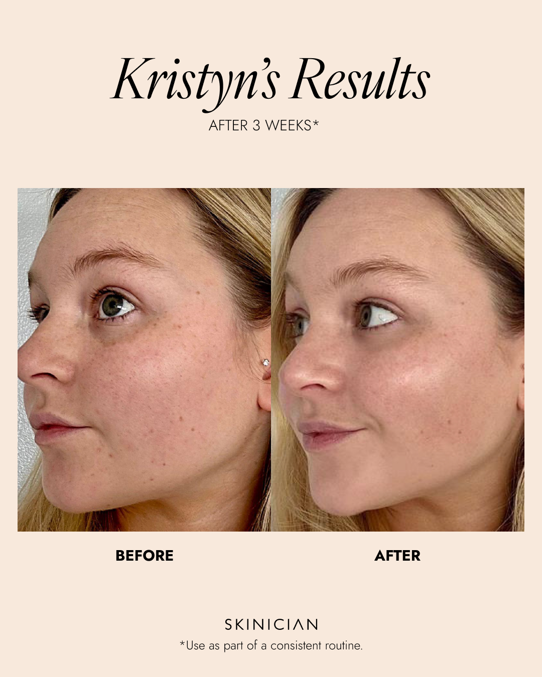Before and after comparison of a woman's face with text indicating results after 3 weeks. Results show an increase in skin hydration and glow