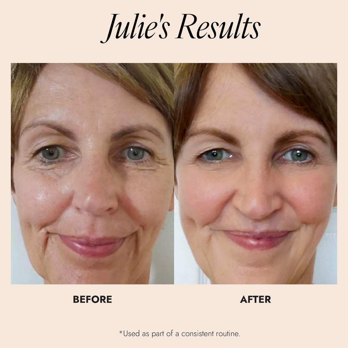 Before and after comparison of a woman's face with text 'Julie's Results' on a beige background.