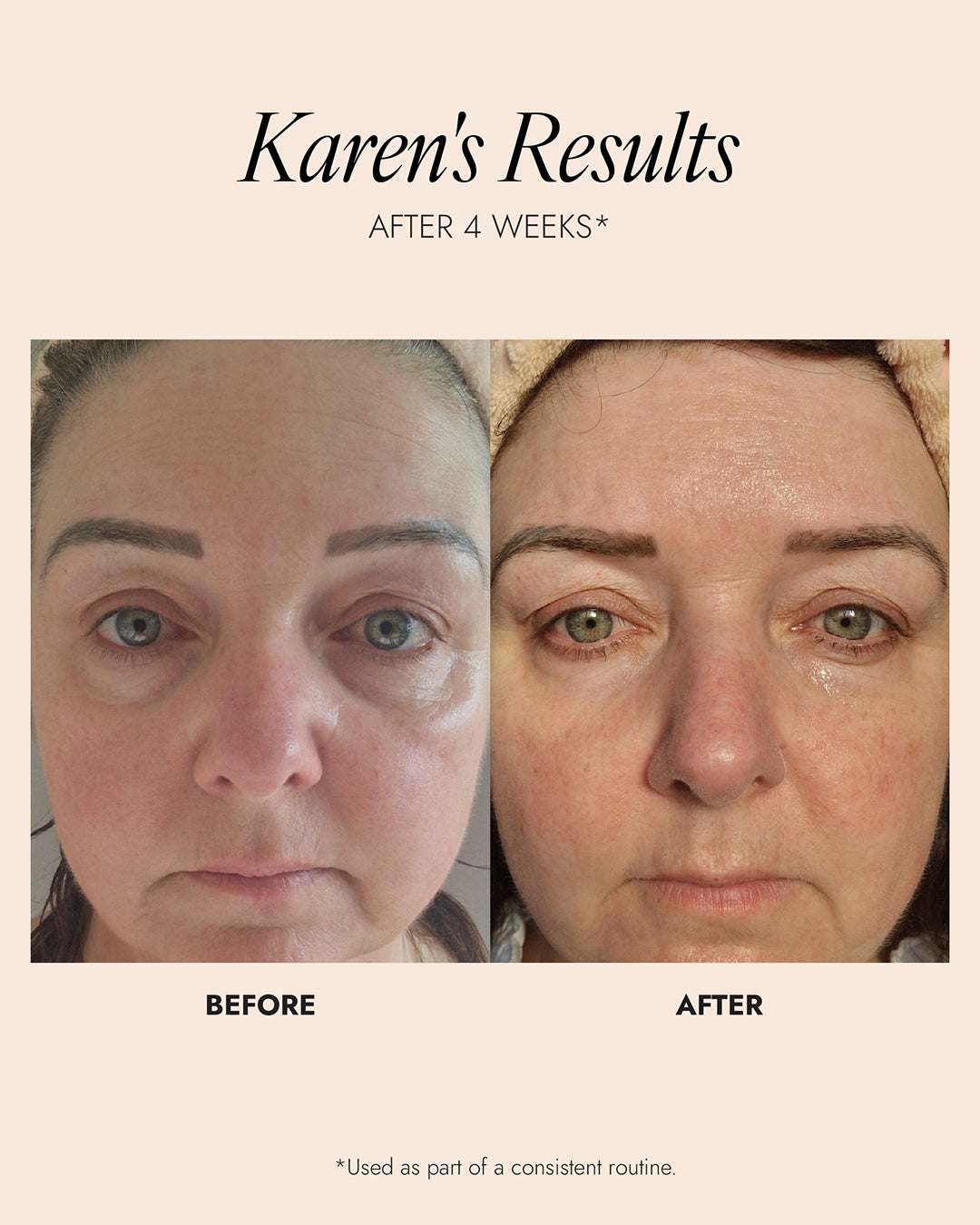 Before and after comparison of a woman's face with text indicating results after 4 weeks. The after image demonstrates a visible improvement in the under eye area.