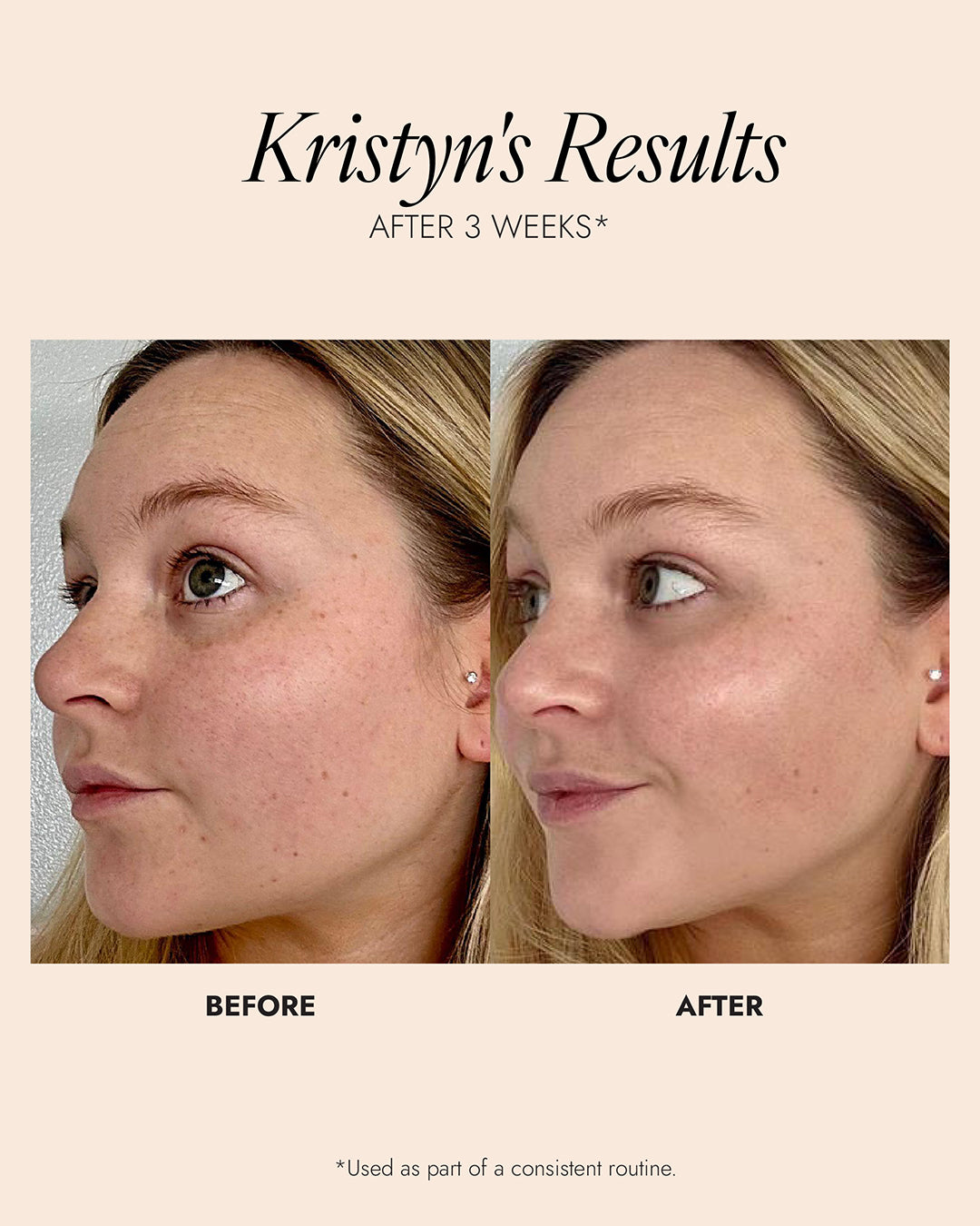 Before and after image of Kristyn's results are using Vitamin C for 3 weeks. The results show improved skin evenness and skin glow.